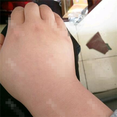 做了副乳吸脂手術(shù)半年了，分享前后對比果圖片~