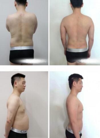 吸脂減肥前后對比圖