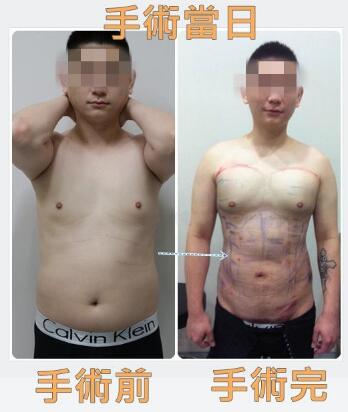 吸脂減肥前后對比圖