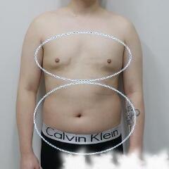 吸脂減肥手術(shù)瘦身，也算一個正能量胖子逆襲的故事吧