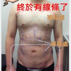 吸脂減肥手術(shù)瘦身，也算一個正能量胖子逆襲的故事吧