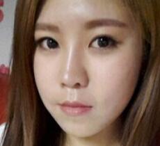 玻尿酸除皺抗衰老去法令紋真實(shí)案例分享