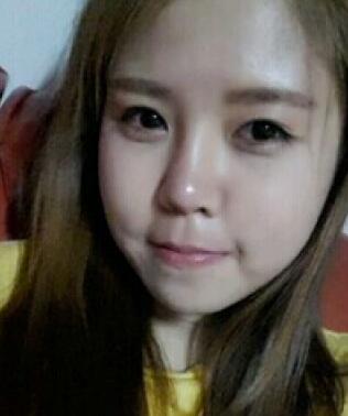 玻尿酸后，法令紋明X減輕了很多