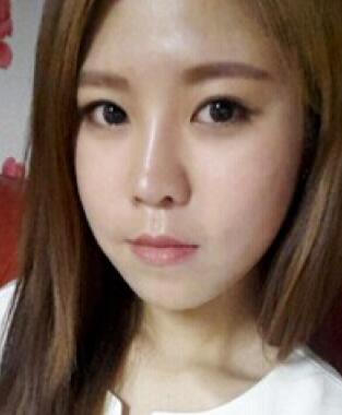 玻尿酸除皺抗衰老去法令紋真實案例分享