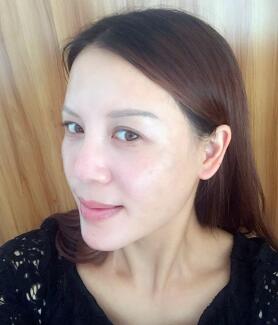 蛋白埋埋蛋白線.提升手術(shù)前后對(duì)比照片，術(shù)后第(一)天