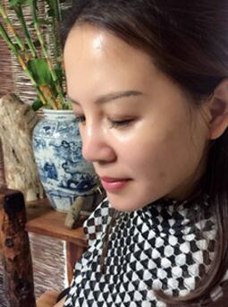 蛋白埋埋蛋白線.提升手術(shù)后恢復(fù)照片