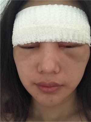 自體脂肪隆眉弓后，更有精神了