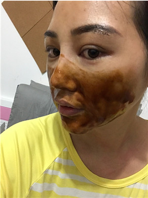 自體脂肪隆眉弓后，更有精神了