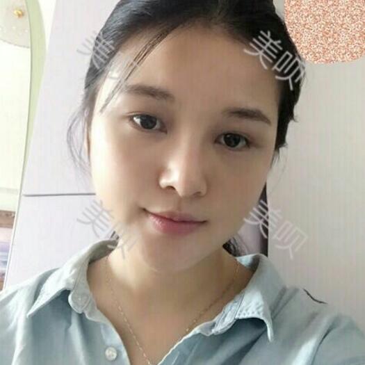 玻尿酸隆鼻改變了大鼻翼給大家分享下我的恢復(fù)過程