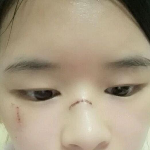 分享手術切除祛疤恢復過程希望對大家有幫助