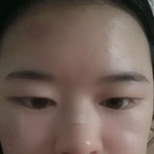 分享手術切除祛疤恢復過程希望對大家有幫助