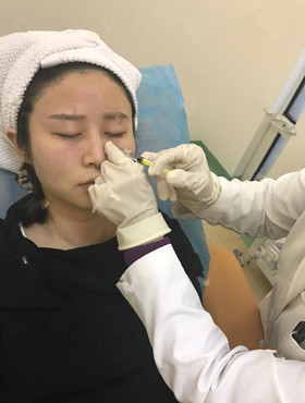 記錄了玻尿酸填充淚溝手術前后過程，還有前后對比圖哦