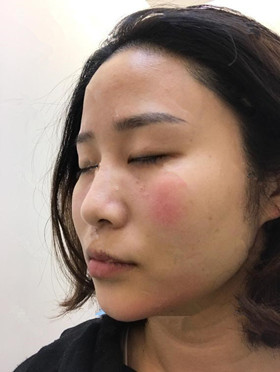 記錄了玻尿酸填充淚溝手術前后過程，還有前后對比圖哦