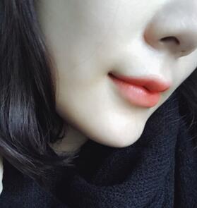 武漢中愛(ài)自體脂肪豐唇+面部填充恢復(fù)記錄