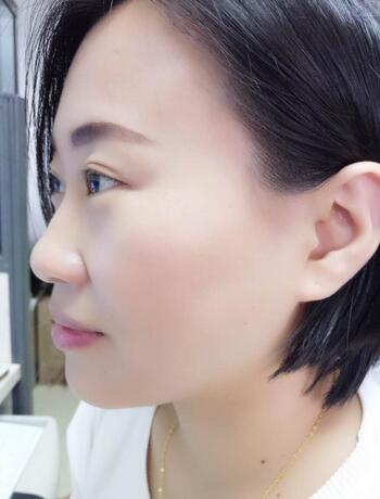 武漢中愛注射瘦臉去魚尾紋一個(gè)月