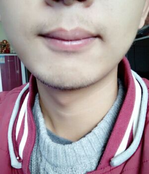 胡須種植后長出來的胡子較為滿意