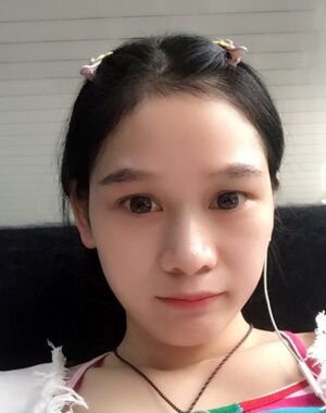 很淡的眉毛做完眉毛種植之后濃密多了