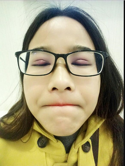 全切雙眼皮讓我告別腫泡眼變女神