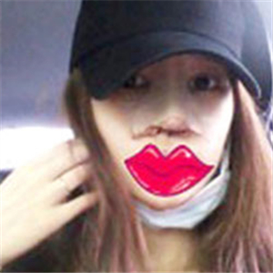 玻尿酸注射隆鼻手術(shù)三個月了，分享我的恢復(fù)過程，還有對比照片哦~