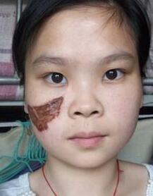 激光去胎記，去大田痣