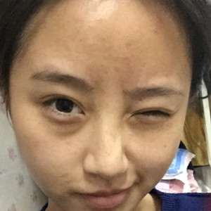 做了玻尿酸隆眉弓，感覺棒棒噠