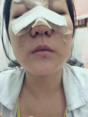 做了隆鼻整形手術，給大家分享一下手術過程，還有對比照片哦