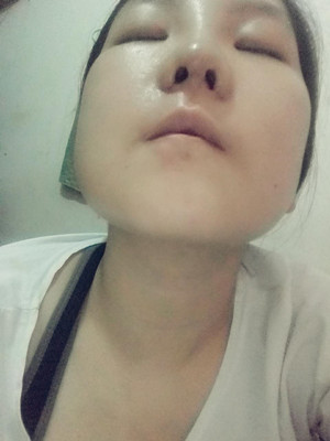 做了隆鼻整形手術，給大家分享一下手術過程，還有對比照片哦