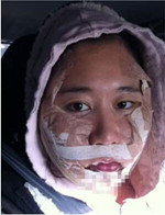 分享下頜角整形手術(shù)前后過(guò)程，還有對(duì)比照哦