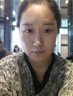 分享下頜角整形手術(shù)前后過(guò)程，還有對(duì)比照哦