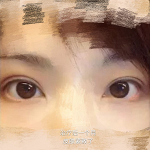 做了眼部電波l皮，一下子年輕了不少啊