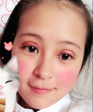 梨花雨割雙眼皮恢復(fù)半年了