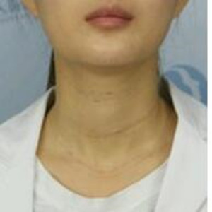 玻尿酸注射去頸紋果真的很明X哦 大家可以去試試