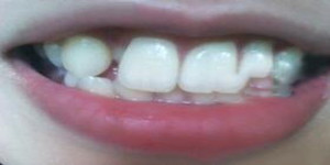 做了美容冠矯正 現(xiàn)在我的牙齒整齊又漂亮