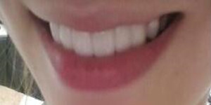 做了美容冠矯正 現(xiàn)在我的牙齒整齊又漂亮