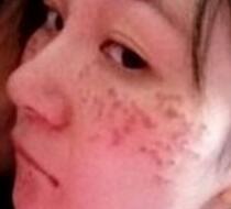 激光去雀斑價(jià)格3800元，術(shù)后恢復(fù)過程和術(shù)后注意事項(xiàng)分享