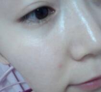 激光去雀斑價(jià)格3800元，術(shù)后恢復(fù)過程和術(shù)后注意事項(xiàng)分享