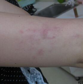 激光祛紅色胎記和跟隨了我20多年的胎記終于說拜拜了