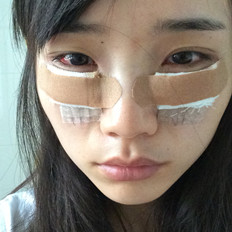 自體脂肪填充淚溝手術(shù)前后對比照片和恢復(fù)過程分享