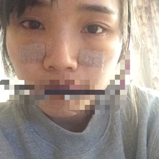 自體脂肪填充淚溝手術(shù)前后對比照片和恢復(fù)過程分享