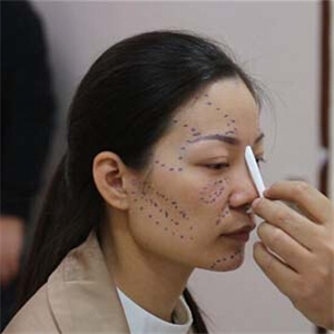 鼻部綜合整形+自體脂肪豐蘋果肌前后對比果圖片分享哦~