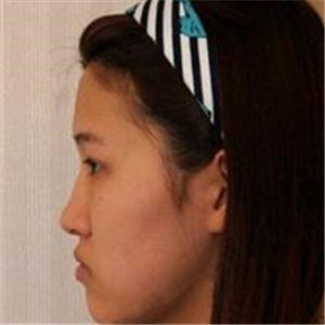 去年做了隆鼻整形，分享恢復(fù)過程和前后對比果圖片哦，