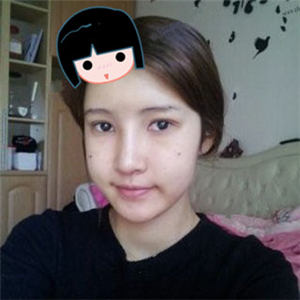 去年做了隆鼻整形，分享恢復(fù)過程和前后對比果圖片哦，