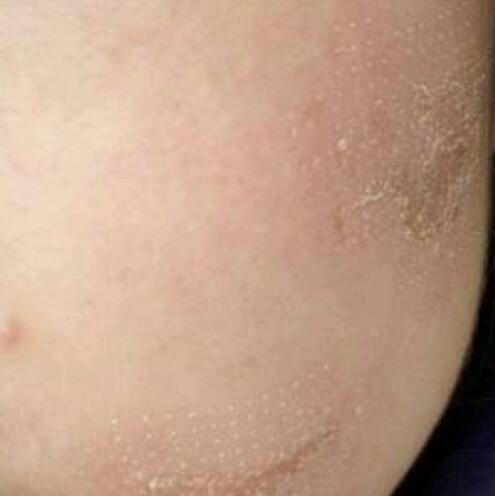 兩次激光祛疤過(guò)程圖片分享給大家做割參考