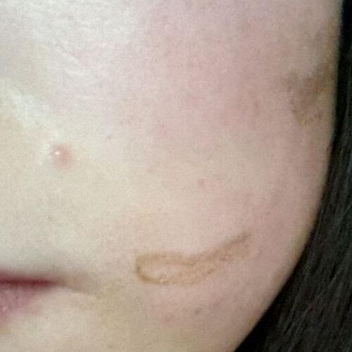 兩次激光祛疤過(guò)程圖片分享給大家做割參考