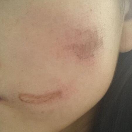 兩次激光祛疤過(guò)程圖片分享給大家做割參考