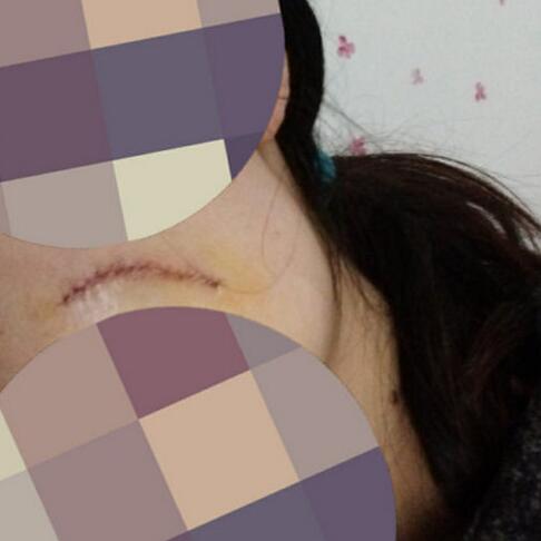 給大家看看我的臉上的手術(shù)切除祛疤過(guò)程圖片