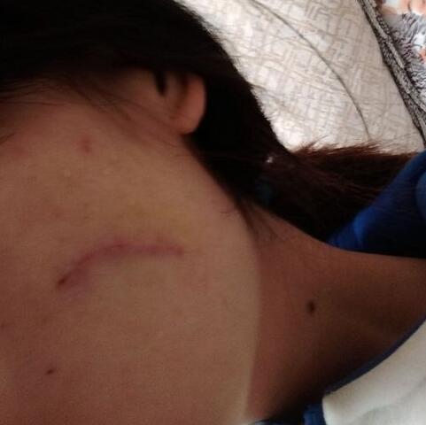 給大家看看我的臉上的手術(shù)切除祛疤過(guò)程圖片