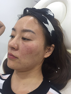 蛋白線面部埋埋蛋白線.提升，改良我的皮膚問題