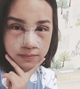 上海韓鏡網(wǎng)紅套餐半個(gè)月經(jīng)歷 雙眼皮多項(xiàng)整形+隆鼻整形+脂肪填充