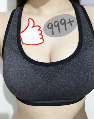 上海韓鏡曼托假體隆胸18天